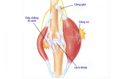 CÁC NHÓM CHẤN THƯƠNG THỂ THAO THƯỜNG GẶP NHẤT