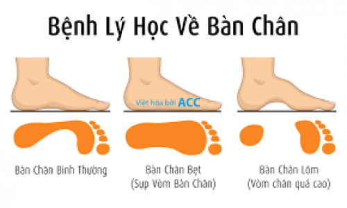 HỘI CHỨNG BÀN CHÂN BẸT