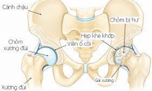 MỘT SỐ LƯU Ý KHI TẬP PHỤC HỒI SAU MỔ THAY KHỚP HÁNG