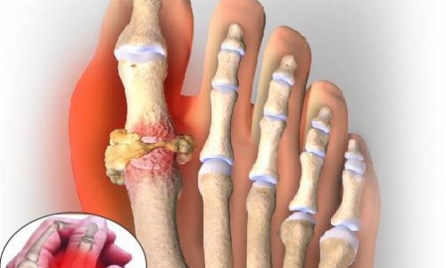 NHỮNG ĐIỀU CẦN BIẾT VỀ BỆNH GOUT