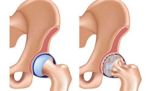 PHÒNG NGỪA THOÁI HÓA KHỚP HÁNG NHƯ THẾ NÀO?