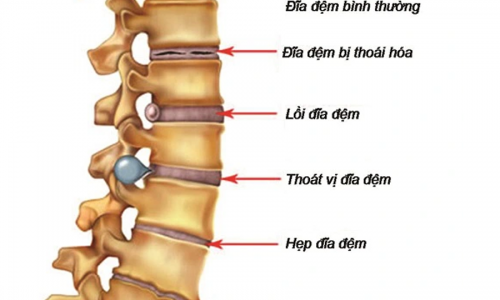 KHÔNG CÓ BỆNH GAI CỘT SỐNG!